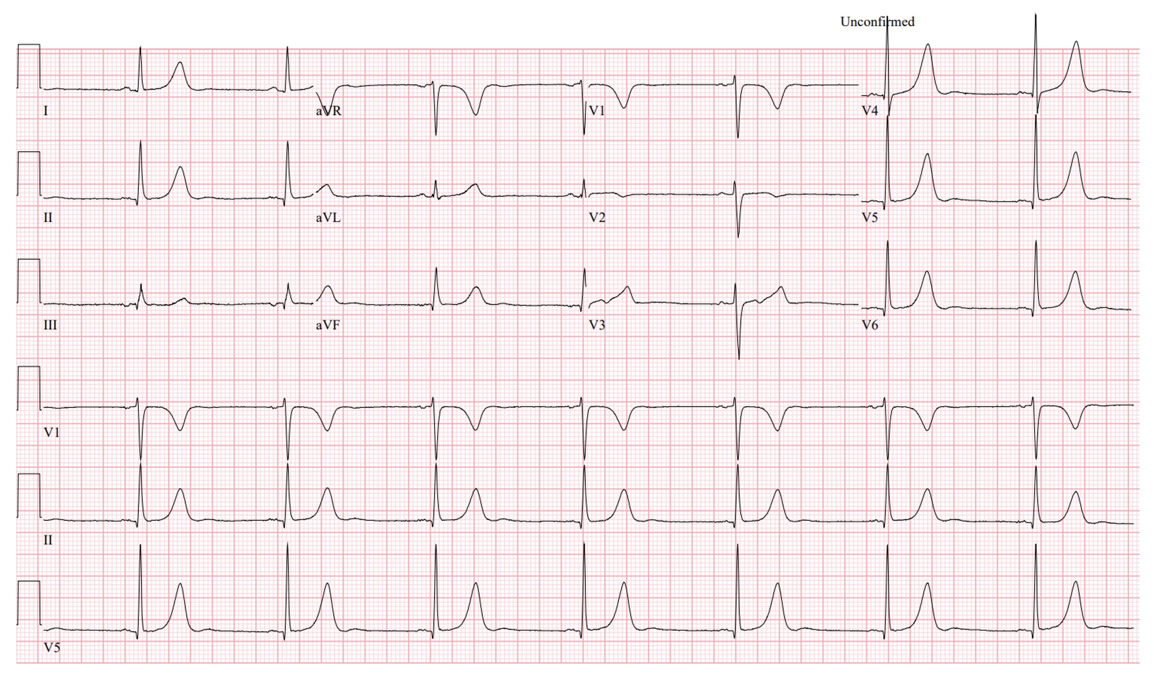 bradycardia ECG