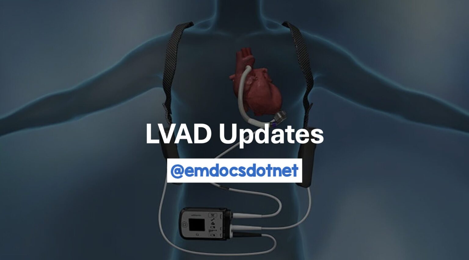 Update on LVADs in the ED: Presentations, Evaluation, and Management ...