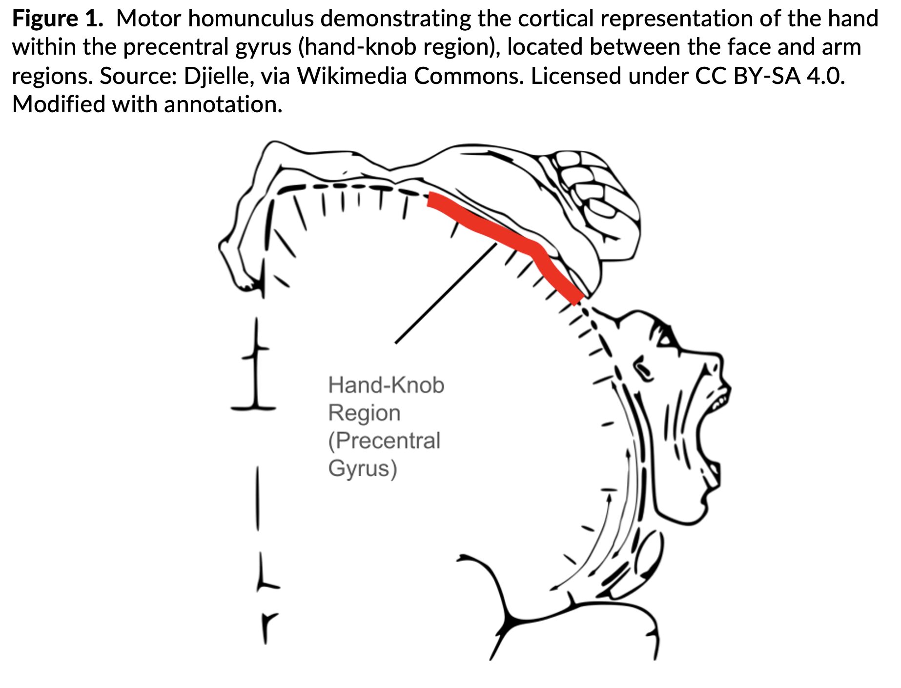 Cortical Hand-Knob Stroke Mimicking Peripheral Nerve Injury