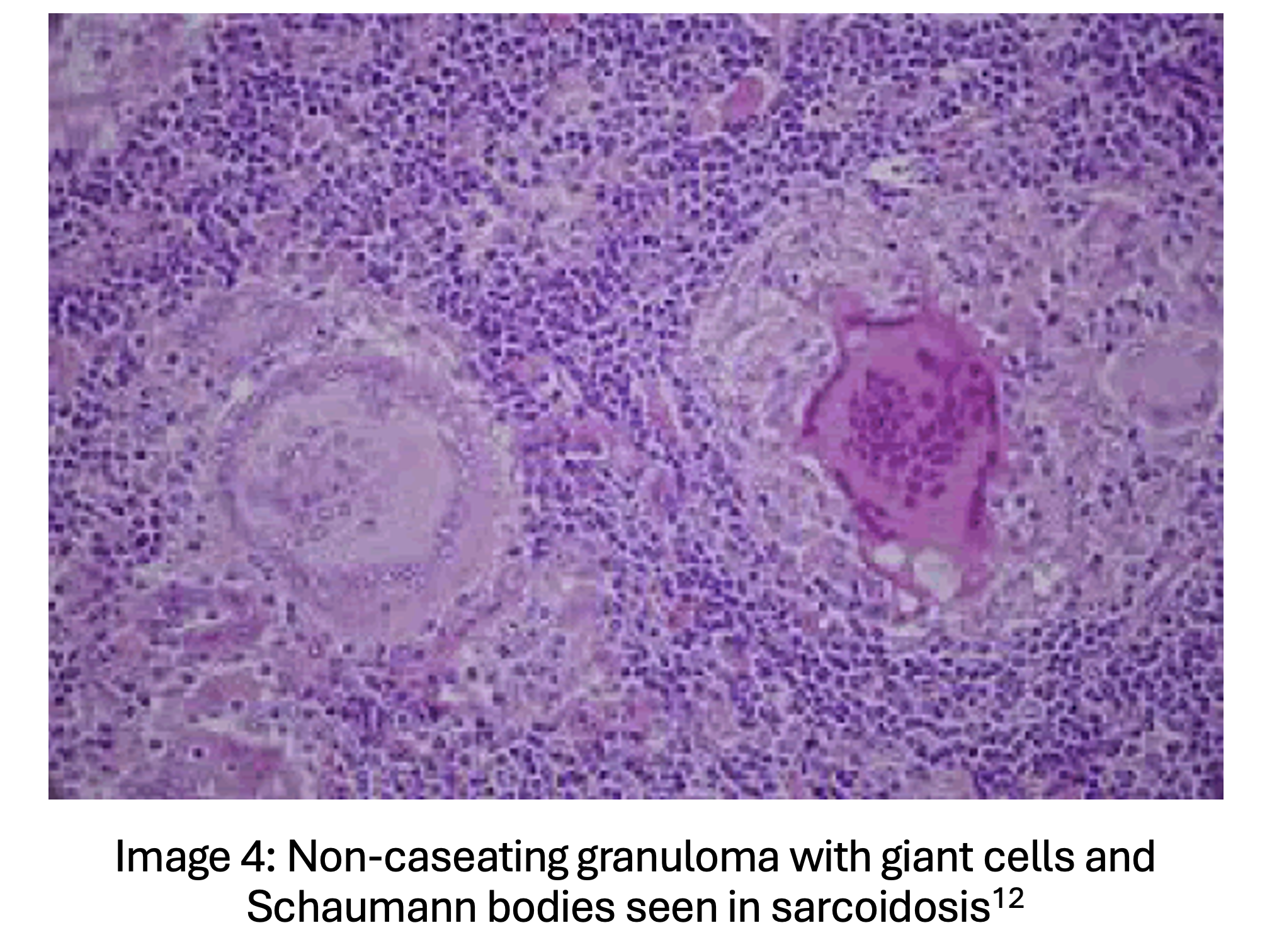 granuloma