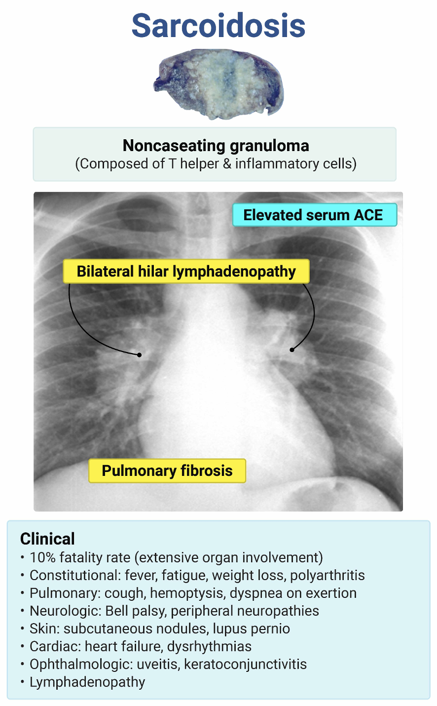 Rosh Sarcoidosis