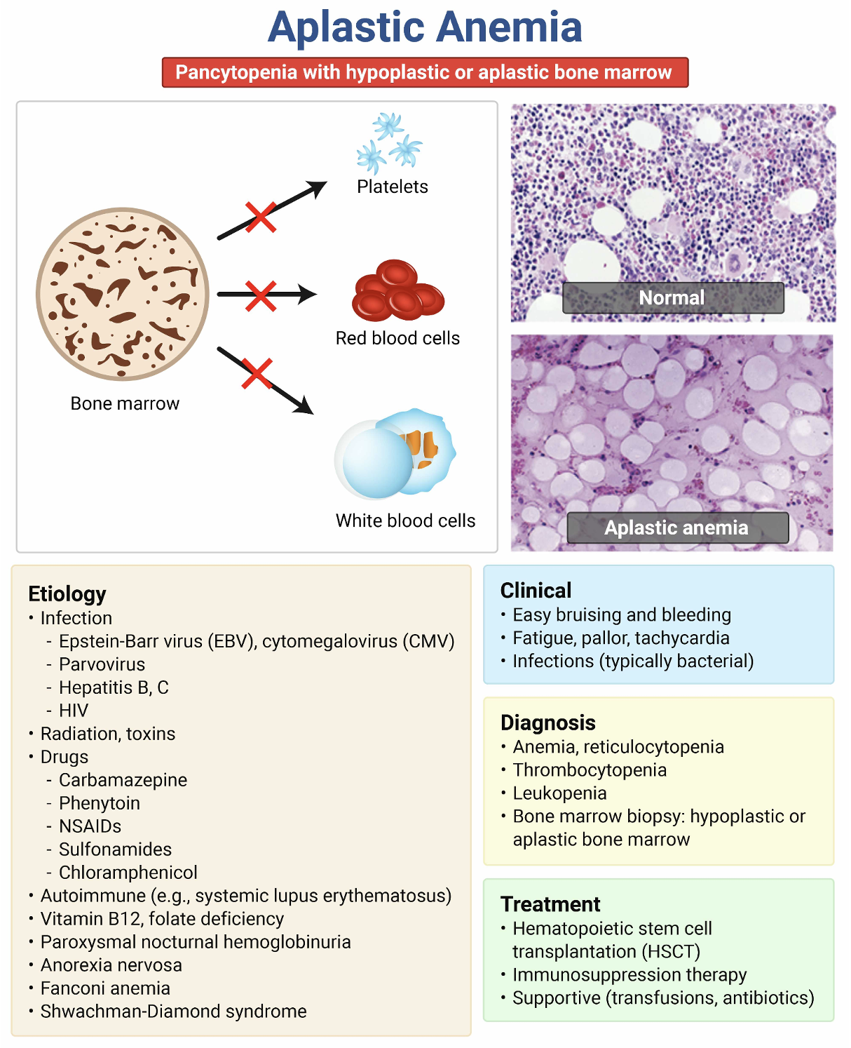 aplastic anemia EM@3AM