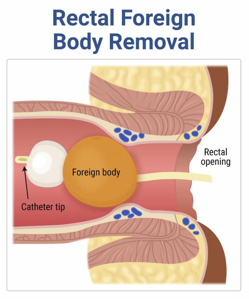Perforation Injuries EM@3AM: Rectal Injuries - emDocs